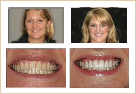 Smile Makeover/Cosmetic Dentistry Actual patients results