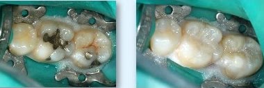 Safe mercury removal before and after results