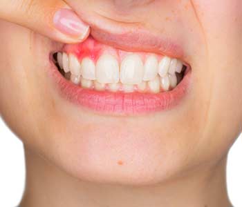 Carlsbad, CA dentist offers advanced gum recession treatment