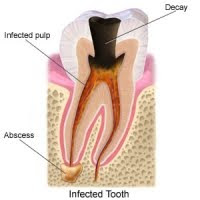 Infections and Treating Infected Teeth
