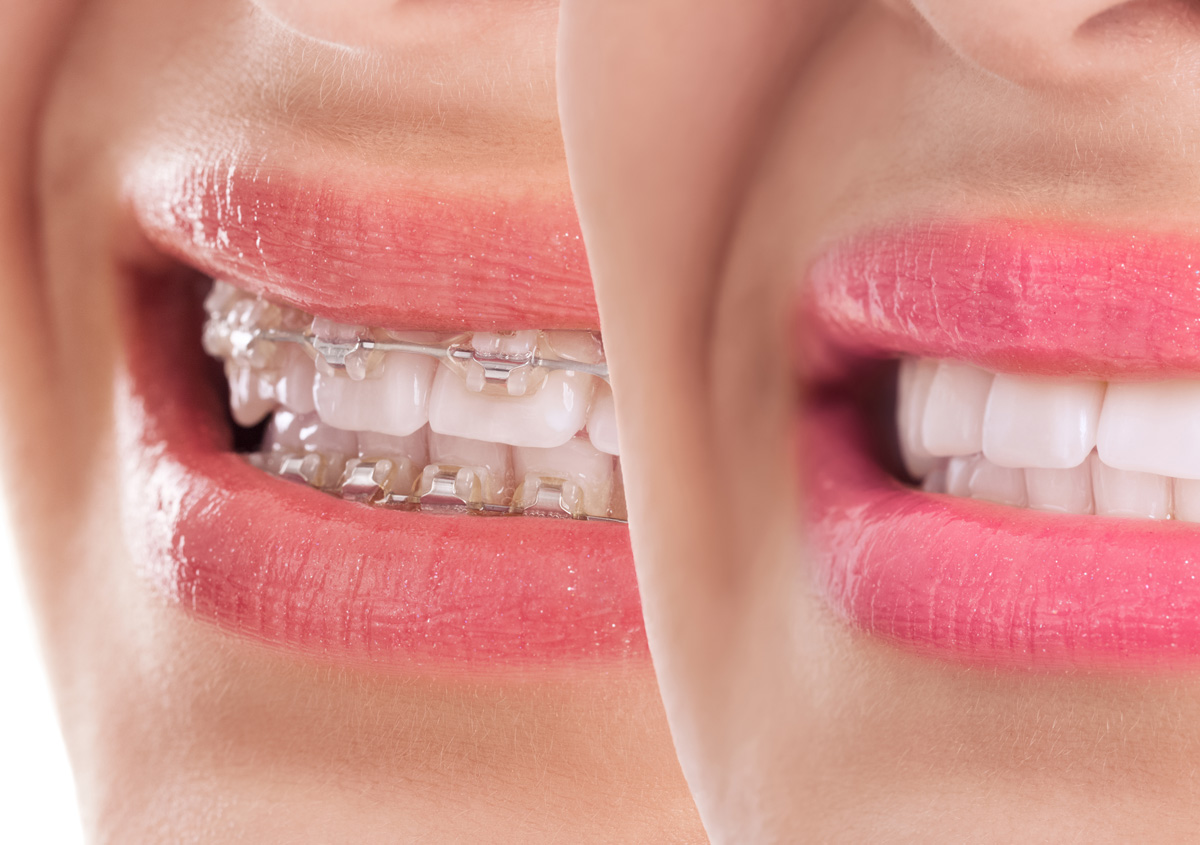 An efficient process of veneers orthodontics improves the look of smiles.