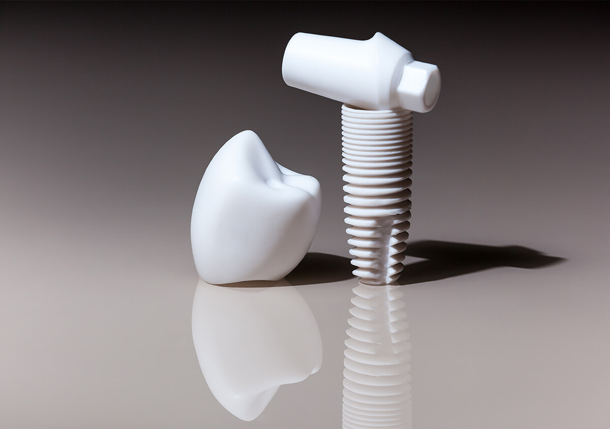 Zirconia Dental Implants in Carlsbad CA Area