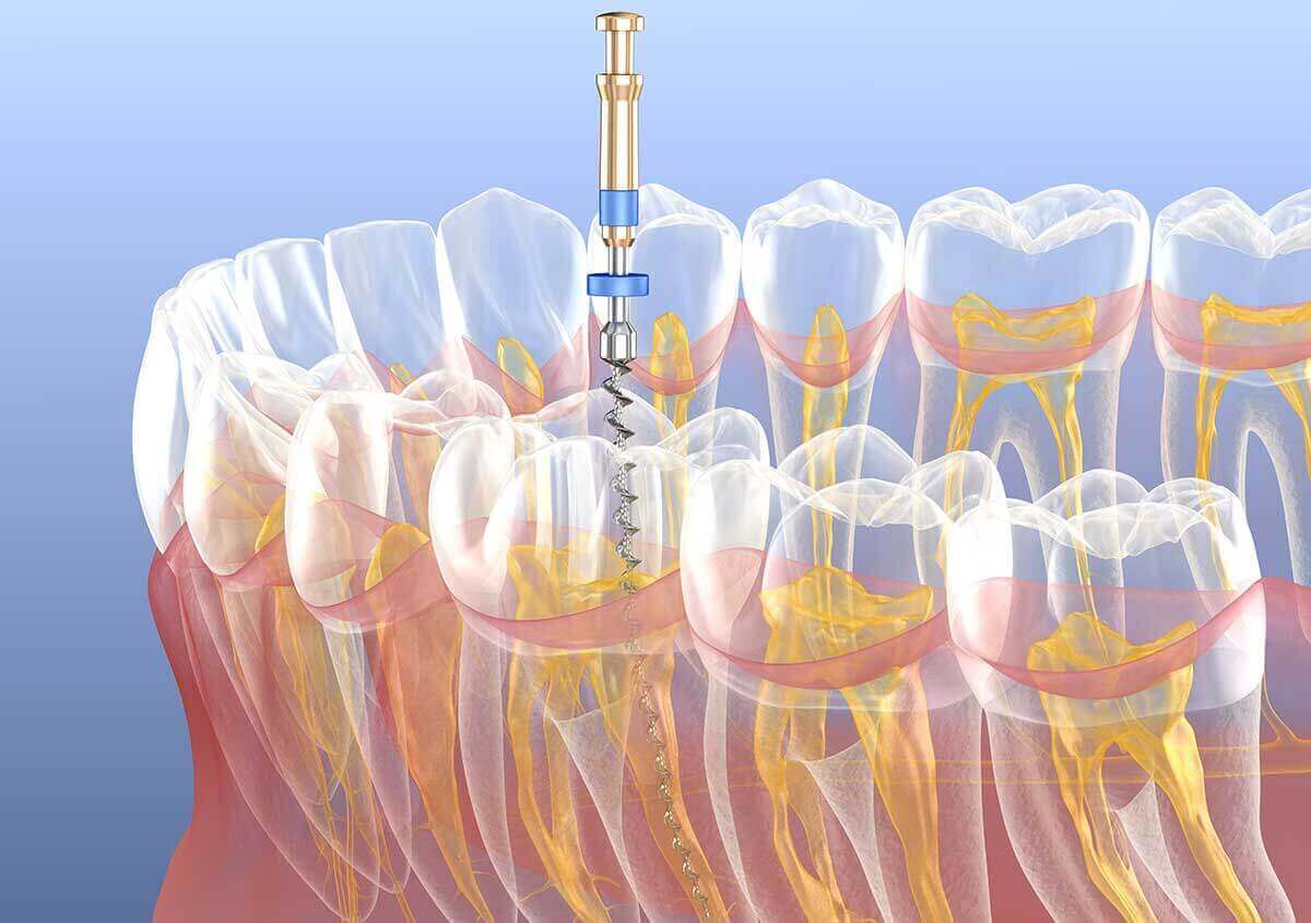 Holistic Alternatives to Root Canal in Carlsbad CA Area