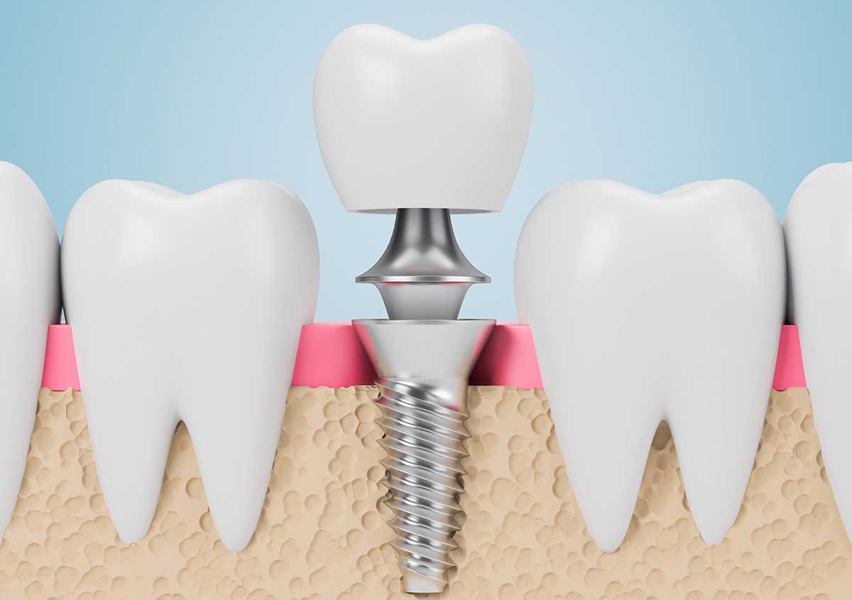 Metal Free Dental Implants in Carlsbad CA Area